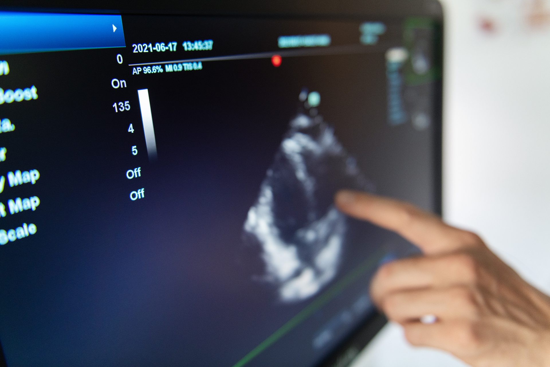 Három ultrahang készülékkel bővült a balassagyarmati kórház eszközparkja
